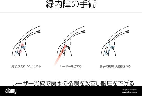 Ilustraciones Cirugía De Glaucoma Ilustraciones Médicas Traducción