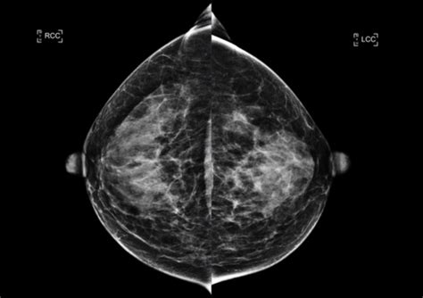 Breast Imaging Flashcards Quizlet