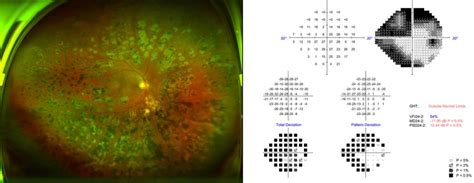 Figure From Management Of Xen Gel Stent Exposure With Conjunctival