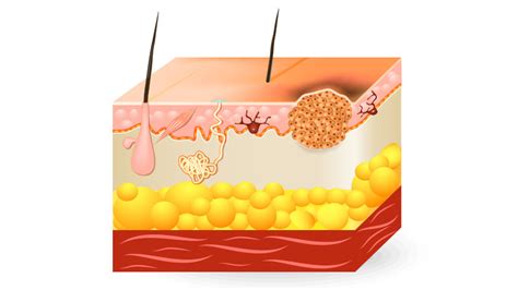 Todo Lo Que Debes Saber Sobre El Carcinoma Basocelular Roche Pacientes