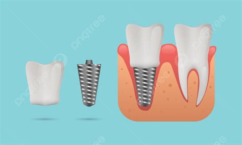 Teeth Dental Implants Vector Hd Images Dental Implant Structure Clean