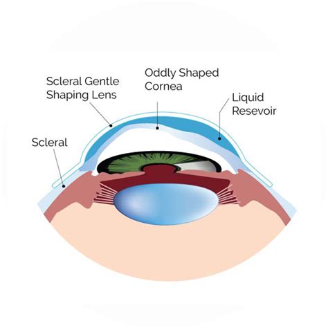 All About Scleral Contact Lenses Dr Sam Dhaliwal And Associates