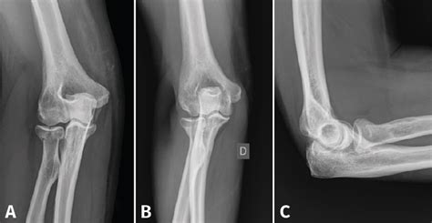 Fracturas del extremo proximal de cúbito y radio FONDOSCIENCE