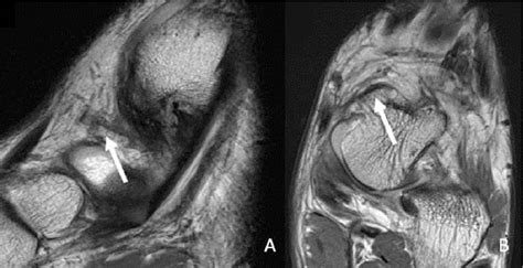 Figure 1 From Mri Imaging Of Impingement Syndromes Of The Ankle