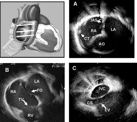 How To Use Intracardiac Echocardiography For Atrial Fibrillation