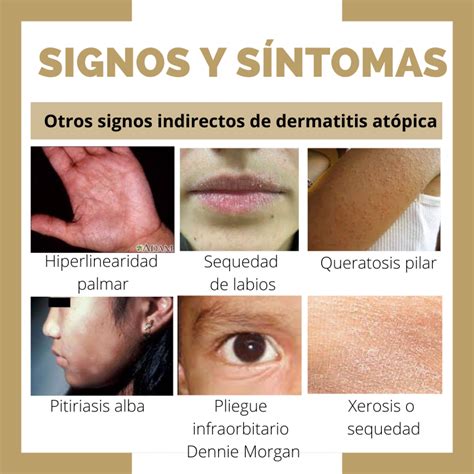 Dermatitis At Pica Nerea Pediatra