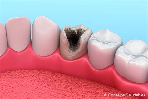 Muela Con Caries Profunda Helene Olinghouse