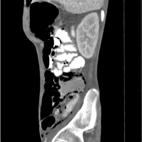 Abdominal Sagittal Computed Tomography Image This Abdominal Reveals