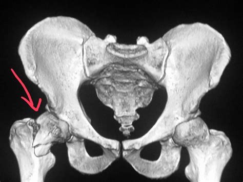 Ct Pelvic Fracture