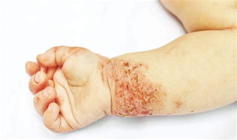 Atopijski dermatitis - Atopik.si