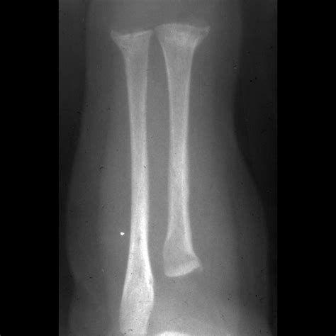 erlenmeyer flask deformity (mnemonic) | pacs