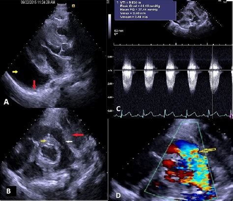 2d Transthoracic Echocardiography In Parasternal Long Axis View Shows