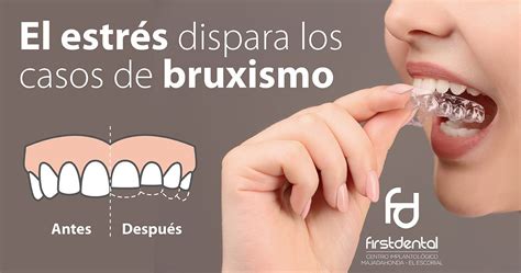 Qué Es El Bruxismo Síntomas Causas Y Tratamiento 54 OFF