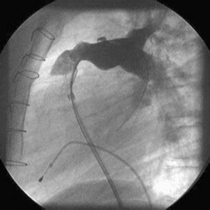 Late Complications after the Arterial Switch Operation | Thoracic Key