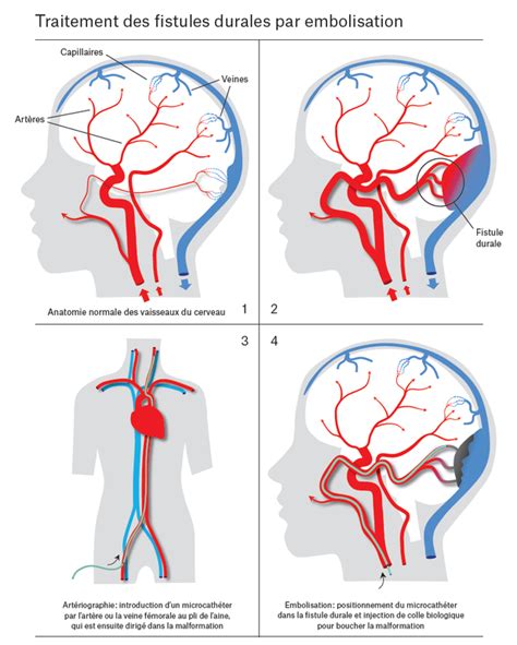 Traitement Des Fistules Durales Par Embolisation Service De