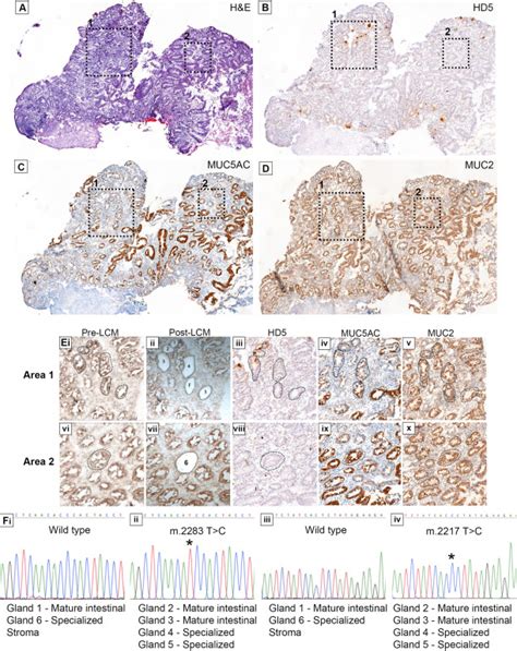 Clonal Transitions And Phenotypic Evolution In Barretts Esophagus