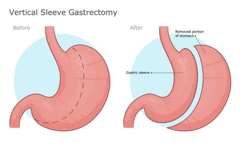 Gastric Sleeve Surgery Al Taie Center