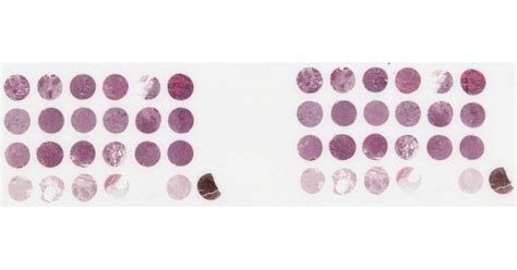 Br247a Breast Cancer Tissue Array With Normal Tissue Including Tnm