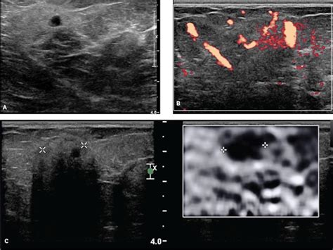 Sonographic Elastography Of Mastitis Sousaris 2016 Journal Of