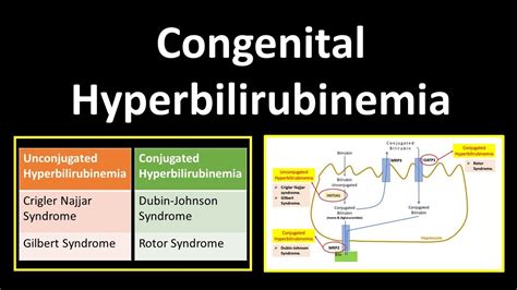 Congenital Hyperbilirubinemia Crigler Najjar Syndrome Gilbert