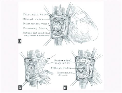 Mustard Operation Pericardial Baffles Are Used To Direct Vena Caval