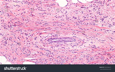 Invasive Lobular Carcinoma: Over 45 Royalty-Free Licensable Stock ...