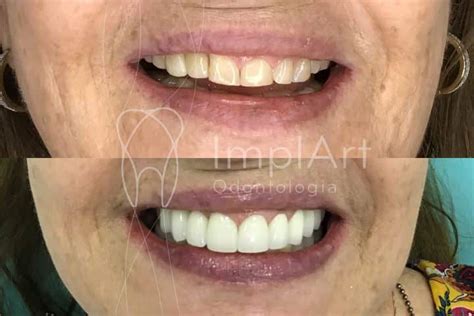 Coroa Porcelana Metal Free Antes E Depois Kb Implart