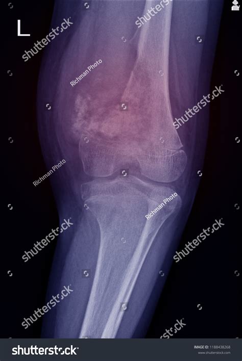 Xray Knee Join Showing Large Osteolytic Stock Photo Edit Now