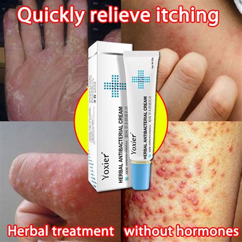 Yoxier Psoriasis Treatment Skin Disease Ointment 20g Does Not Contain Hormones Effectively