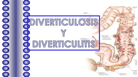 Solution Diverticulosis Y Diverticulitis Ppt Listo Studypool