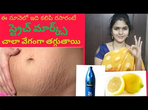 remove stretch marks permanently  home  teluguhow  remove