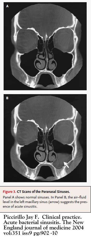 Acute Sinusitis X Ray