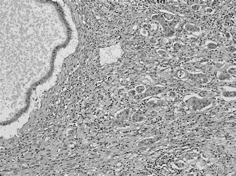 Mucous Cyst Histology