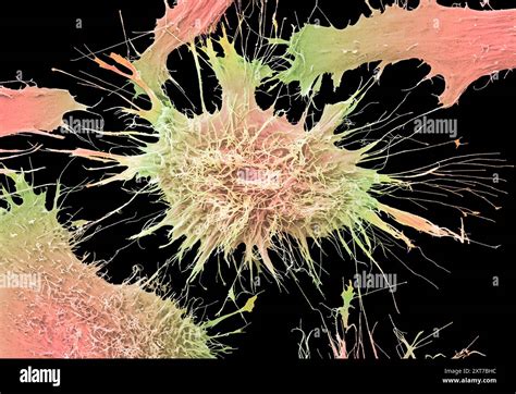 Cervical Cancer Cells Coloured Scanning Electron Micrograph Sem The