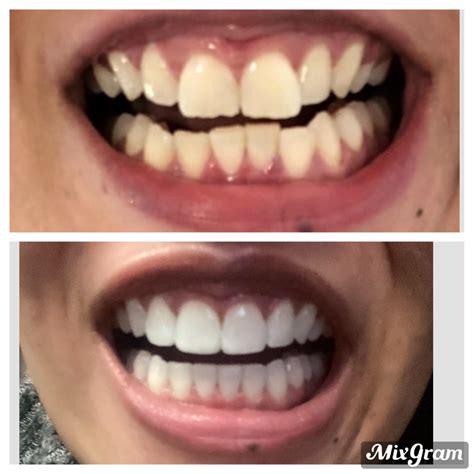 How Does Invisalign Lite Work At Jason Anderson Blog