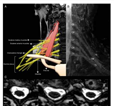 Figure From High Resolution Neurography Of The Brachial Plexus By