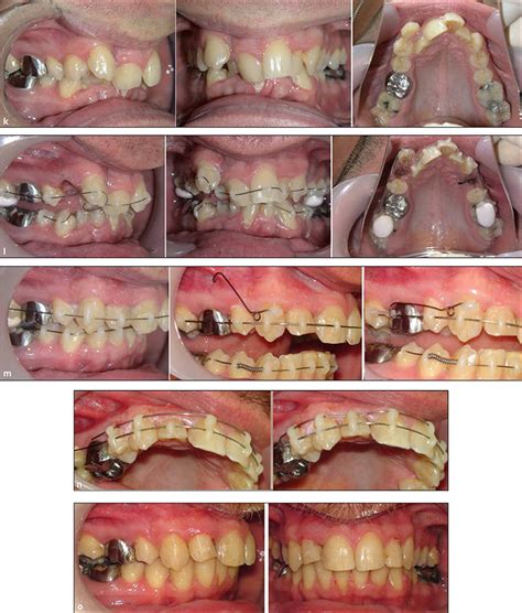 JLE L Orthodontie Française Repousser les limites des possibilités