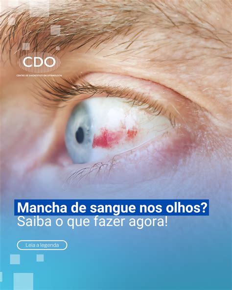 O Que Fazer Quando Aparece Uma Mancha Vermelha No Olho