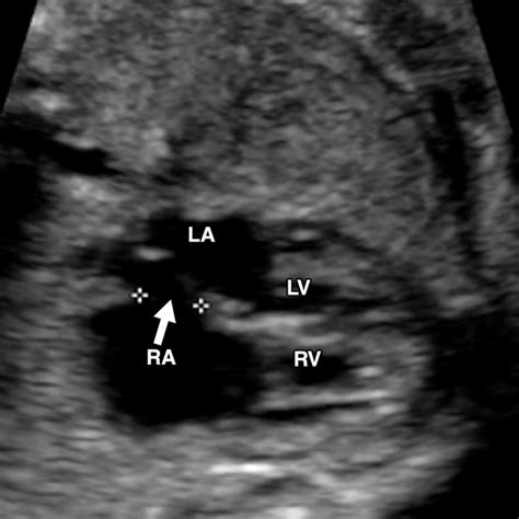 Ultrasound Of Fetal Cardiac Anomalies Ajr