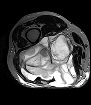 Myxoid Liposarcoma Image Radiopaedia Org