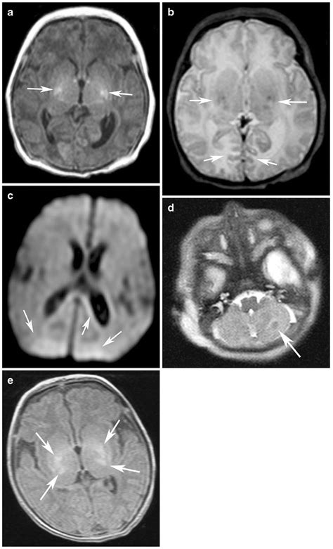 Examples Of Mri Regional Scores A T1 W Image Score Of Bilateral Globus Download Scientific