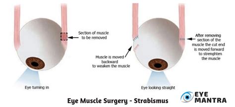 Eye Muscle Surgery | Facts, Procedure, Recovery and Risks