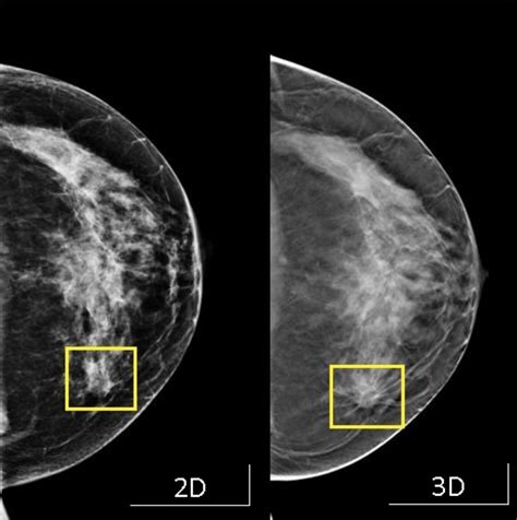 Mamografía 3d O Tomosíntesis Digital De Seno Diagnostimed Imágenes