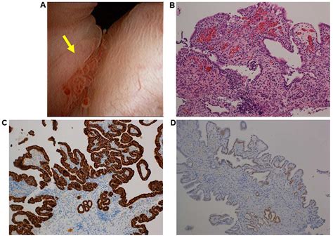 Nephrogenic Adenoma Histology