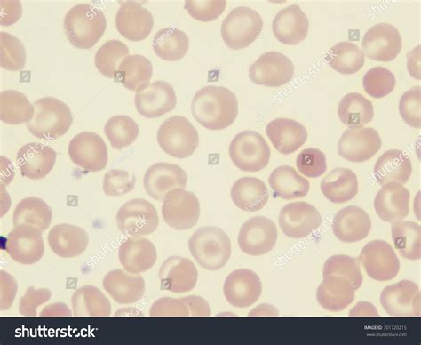 Target Cells Sickle Cell Disease Stock Photo 701720215 | Shutterstock