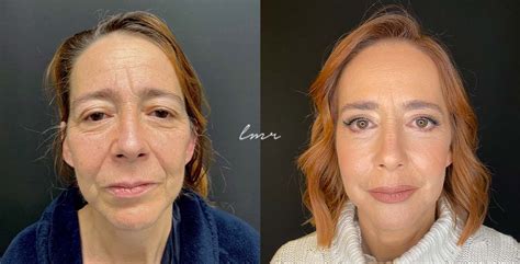 Top Peeling Qu Mico Antes E Depois