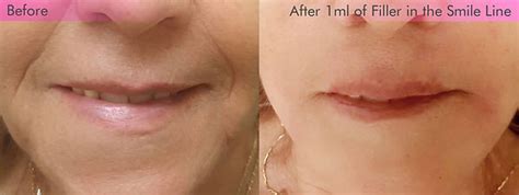 Fillers For Smile Lines Cheek And Jowl Salt Lake City Botox And Fillers