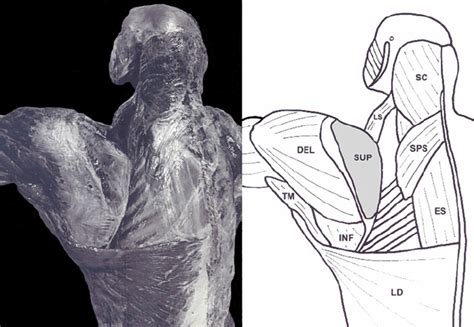 Dissection And Anatomical Drawing Of The Dorsal Region Of The Shoulder