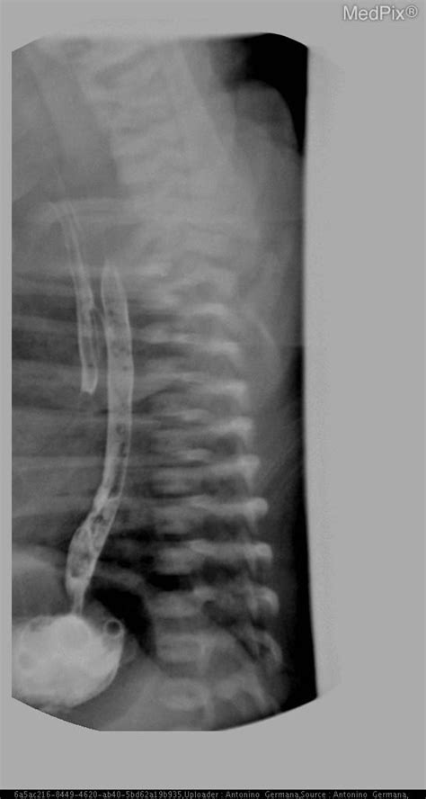 Tracheoesophageal Fistula H Type