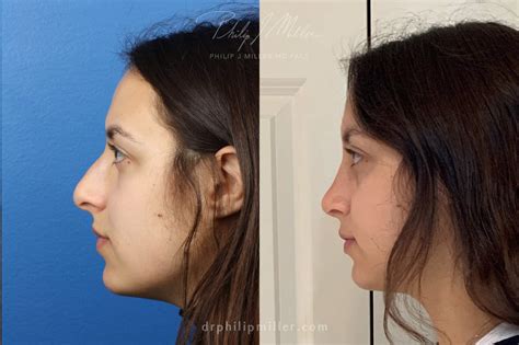 New York Rhinoplasty Nose Job Expert Dr Philip Miller